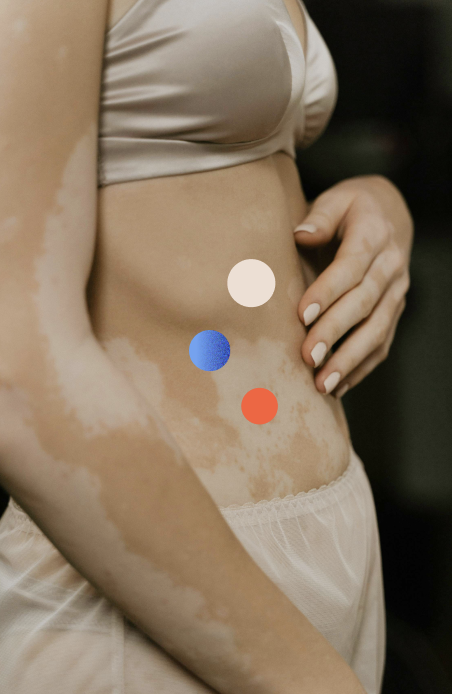 Nahaufnahme eines Bauchbereichs einer Person mit Vitiligo, die drei farbige Punkte (weiß, blau und rot) auf der Haut zeigt.